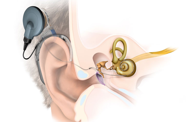 La tecnología avanza en la recuperación de la audición