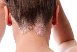Existen diferentes manifestaciones de esta patología inflamatoria de la piel, que se diferencian según las áreas donde se formen las lesiones, su extensión y el posible daño articular