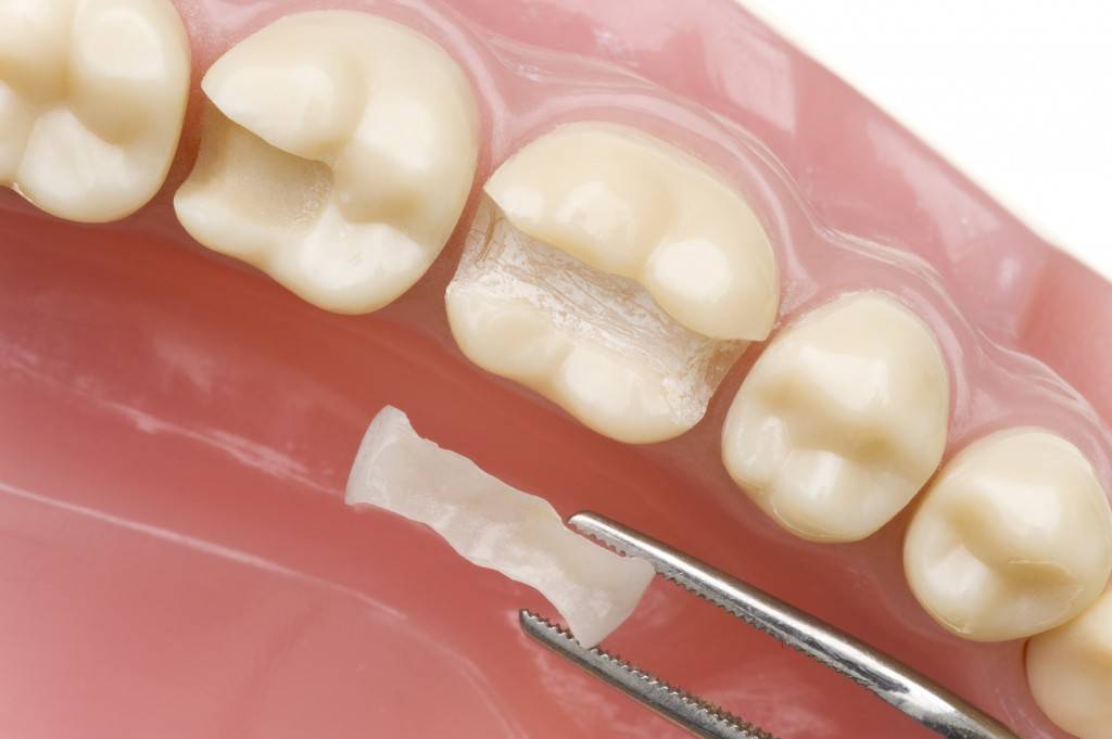 La pulpotomía es un tratamiento muy común en los niños, debido a que tiene como objetivo curar las piezas dentales temporales -los dientes de leche