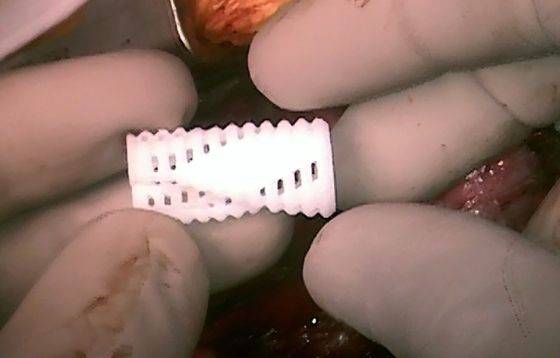 Implantes impresos en 3D hacen respirar a niños con malformación de tráquea