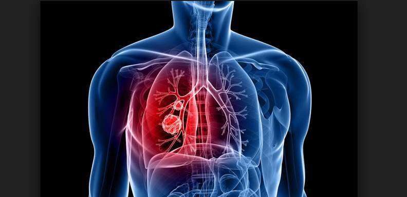 Un equipo de investigadores del Centro Nacional de Investigaciones Oncológicas (CNIO) de España logró frenar el crecimiento del carcinoma de pulmón -el tipo de cáncer que más muertes causa en el mundo- en ratones, gracias a una innovadora técnica que tiene como diana los telómeros.
