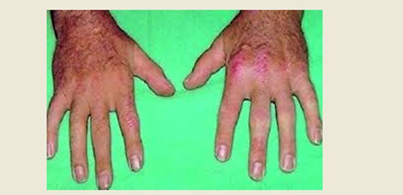 Le ecografía se ha convertido en una de las técnicas de imagen que facilita la detección de artropatías asintomáticas