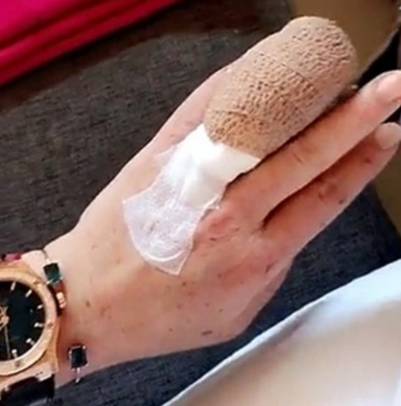 La actriz tuvo que someterse a una cirugía de emergencia para volver a unir la parte del dedo que había resultado cortada. 